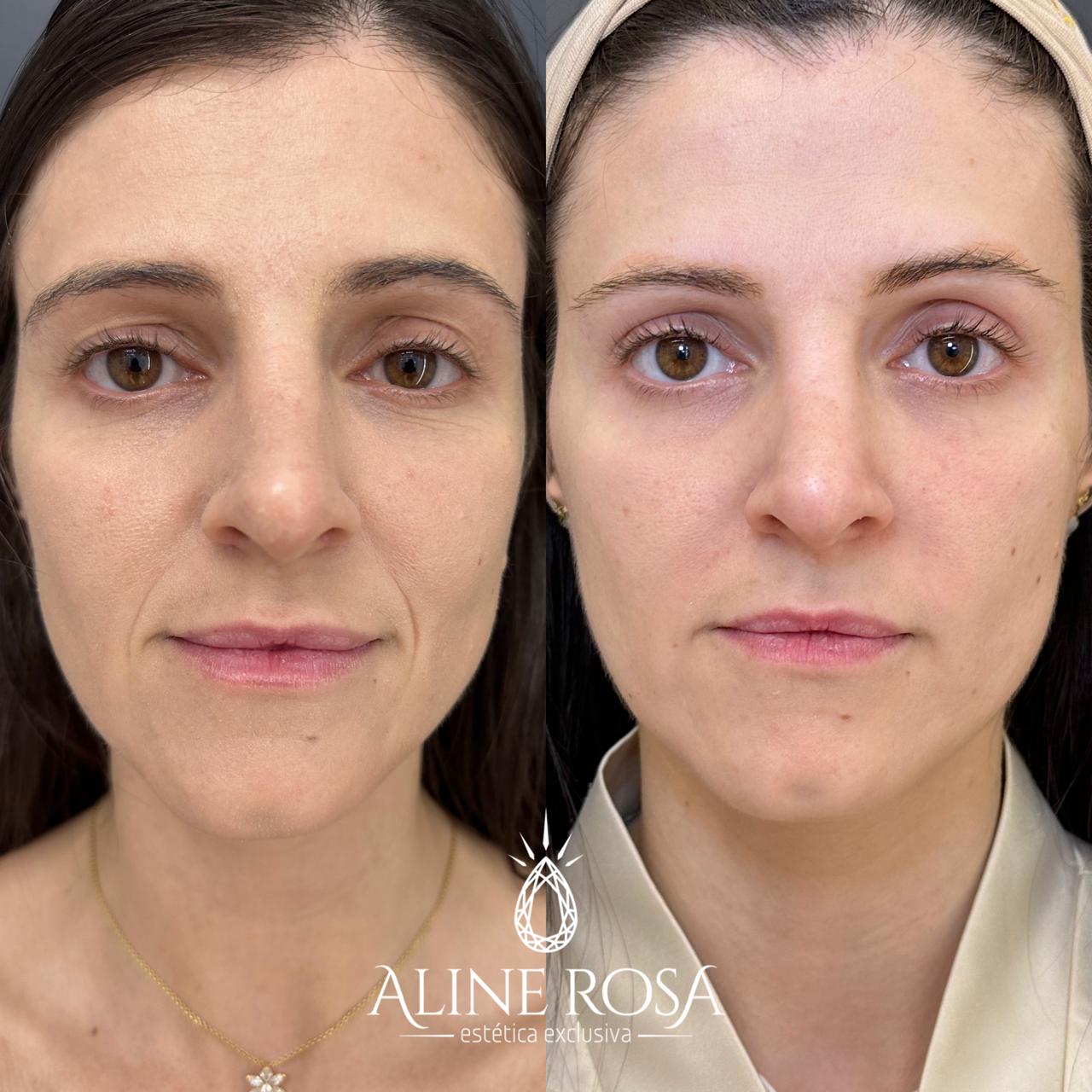 Bioestimulador Facial